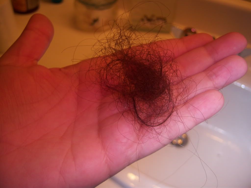 hair photo:hypothyroidism hair loss 